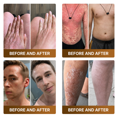 【Made and Shipped from UK 】🚑DOCTIA® Botox & Bee Venom Advanced Recovery Cream—For Wrinkles, Sagging Skin, Skin Tags & Rough Bumps⚡
