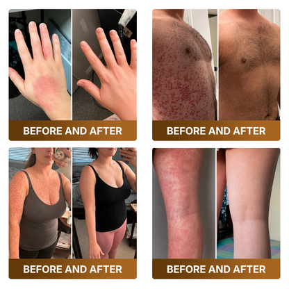 【Made and Shipped from UK 】🚑DOCTIA® Botox & Bee Venom Advanced Recovery Cream—For Wrinkles, Sagging Skin, Skin Tags & Rough Bumps⚡
