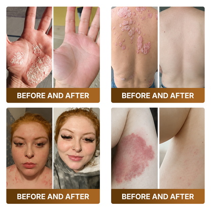 【Made and Shipped from UK 】🚑DOCTIA® Botox & Bee Venom Advanced Recovery Cream—For Wrinkles, Sagging Skin, Skin Tags & Rough Bumps⚡