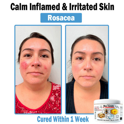 TO𝑫A𝐇OF®🏥 𝑩𝒆𝐞 𝑽𝐞𝒏𝒐𝒎 𝑴𝒖𝒍𝒕𝒊-𝑺𝒚𝒎𝒑𝒕𝒐𝒎 𝑺𝒌𝒊𝒏 𝑻𝒓𝐞𝒂𝒕𝒎𝒆𝒏𝒕 𝑪𝒓𝐞𝒂𝒎 (👨‍⚕𝑵𝑷𝑭 𝑹𝑬𝑪𝑶𝑴𝑴𝑬𝑵𝑫𝑺)⚡