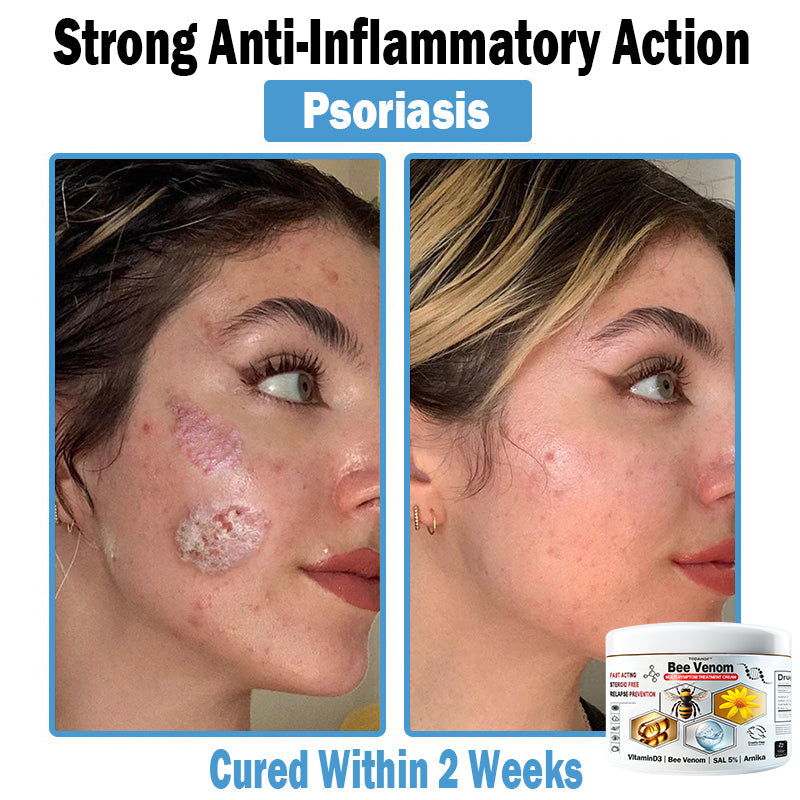 TO𝑫A𝐇OF®🏥 𝑩𝒆𝐞 𝑽𝐞𝒏𝒐𝒎 𝑴𝒖𝒍𝒕𝒊-𝑺𝒚𝒎𝒑𝒕𝒐𝒎 𝑺𝒌𝒊𝒏 𝑻𝒓𝐞𝒂𝒕𝒎𝒆𝒏𝒕 𝑪𝒓𝐞𝒂𝒎 (👨‍⚕𝑵𝑷𝑭 𝑹𝑬𝑪𝑶𝑴𝑴𝑬𝑵𝑫𝑺)⚡