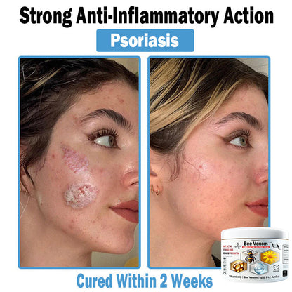 TO𝑫A𝐇OF®🏥 𝑩𝒆𝐞 𝑽𝐞𝒏𝒐𝒎 𝑴𝒖𝒍𝒕𝒊-𝑺𝒚𝒎𝒑𝒕𝒐𝒎 𝑺𝒌𝒊𝒏 𝑻𝒓𝐞𝒂𝒕𝒎𝒆𝒏𝒕 𝑪𝒓𝐞𝒂𝒎 (👨‍⚕𝑵𝑷𝑭 𝑹𝑬𝑪𝑶𝑴𝑴𝑬𝑵𝑫𝑺)⚡